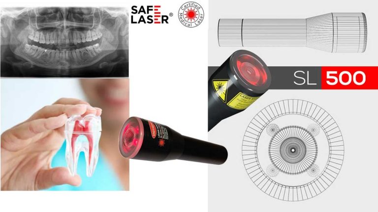 Fogmentés Safe Laser készülékkel