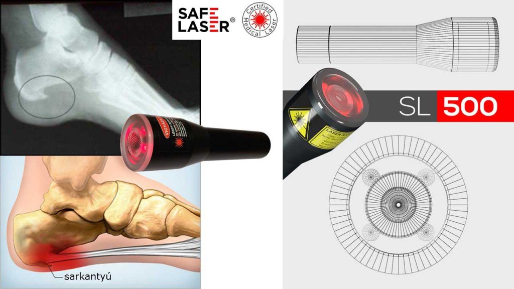 Sarokcsont gyulladás gyógyítása Safe Laser-rel