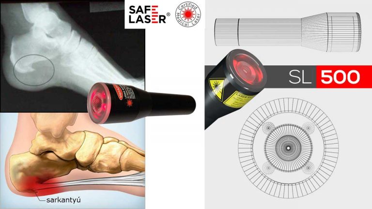 Sarokcsont gyulladás gyógyítása Safe Laser-rel
